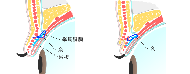 スーパー埋没法